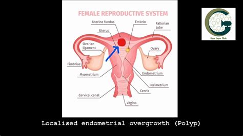 How To Remove Polyps In Uterus Naturally : Uterine polyp surgery ...