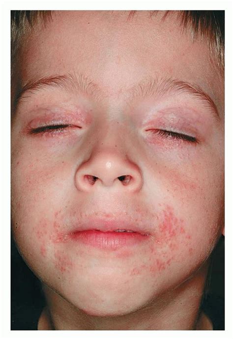 periorificial dermatitis in children - pictures, photos