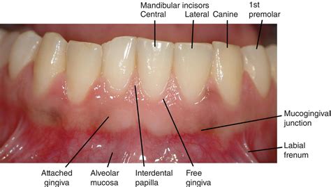 Mucogingival Junction