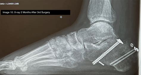 Tongue-Type Calcaneal Fracture Image 10 Annotated - JETem