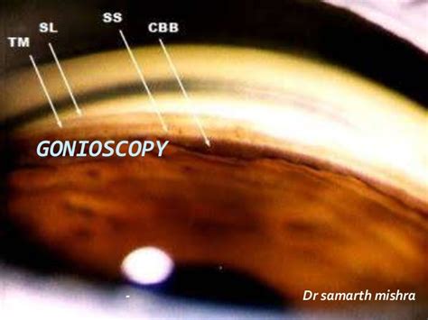 Gonioscopy: gonioscopic lenses, principle and clinical aspects