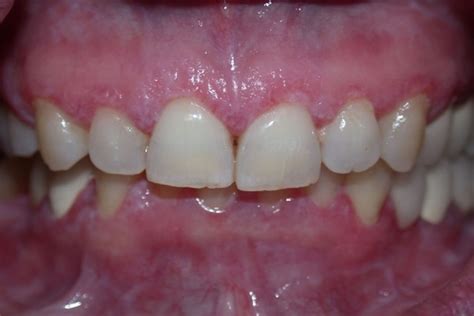 Gingivitis Symptoms