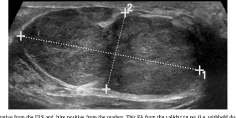 Figure 5 from Distinction between phyllodes tumor and fibroadenoma in breast ultrasound using ...