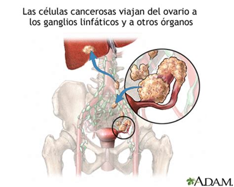 Metástasis de cáncer ovárico: MedlinePlus enciclopedia médica illustración