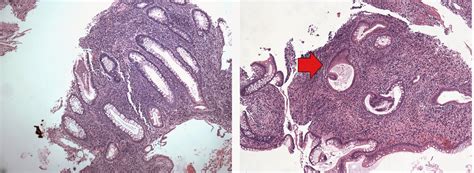 GASTROINTESTINAL AND LIVER HISTOLOGY PATHOLOGY ATLAS: COLON: INFLAMMATORY POLYP ( AKA PSEUDOPOLYP)