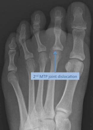 MTP Joint Dislocation | Mr Malik Orthopaedic Consultant