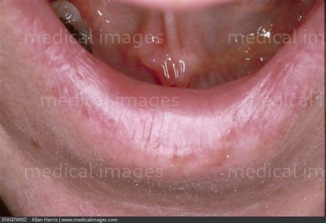 STOCK IMAGE, oral medicine submandibular gland swelling large lump ...