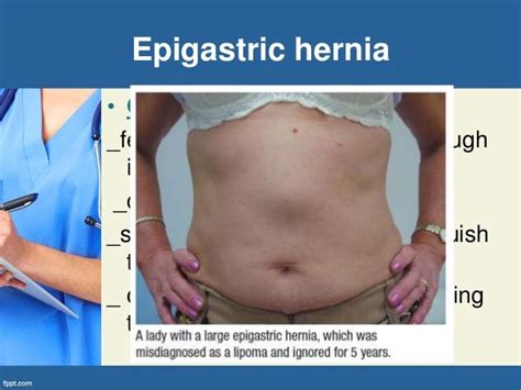 Abdominal wall hernia