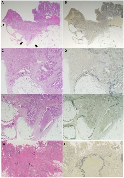 Histological features of serosal invasion in the case shown in Figure... | Download Scientific ...