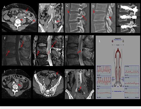 Acute occlusion of the left common iliac artery (A, B, I, J, and K) CT ...