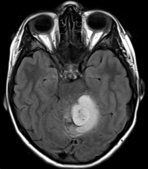 Pilocytic Astrocytoma - Neuro MR Case Studies - CTisus CT Scanning