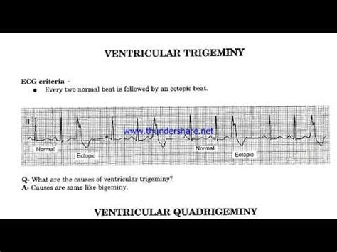 Ventricular Bigeminy, Trigeminy & Quadrigeminy - YouTube