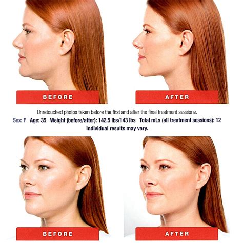 Kybella, Charleston – Double Chin Removal, Best Nonsurgical Option | Dr. Rodwell