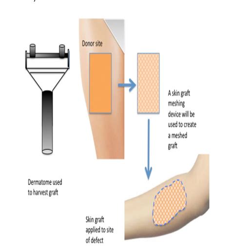 Skin Graft Surgery 9/14/2020