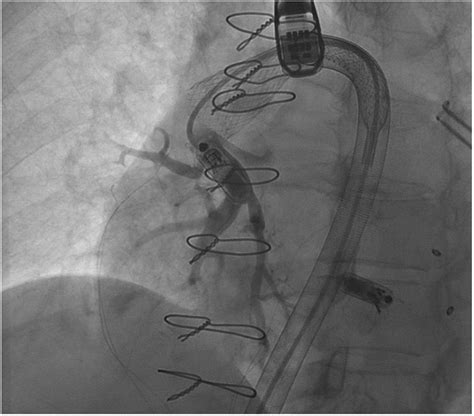 Successful removal of a leadless pacemaker from the pulmonary artery via a novel basket ...