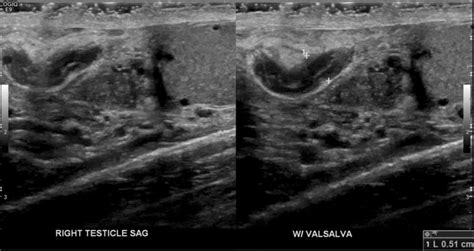 a US shows a vein in the pampiniform plexus that measures (b) 5 mm... | Download Scientific Diagram