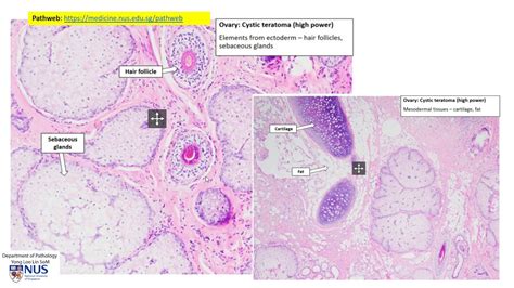 Teratoma Histology