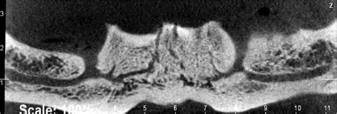 Mandibular incisive canal on CBCT scan | Download Scientific Diagram