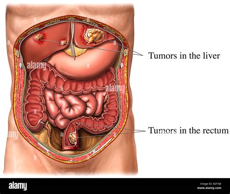 Colon Cancer with Metastasis to the Liver Stock Photo: 7710823 - Alamy