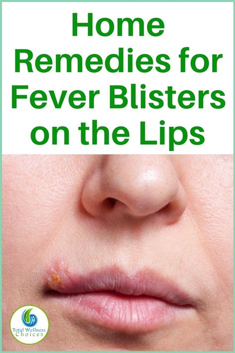 13 Natural Home Remedies for Fever Blisters on the Lips | Home remedies ...