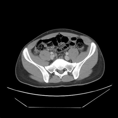 Appendicitis Ct Radiopaedia It is a very common condition in general ...