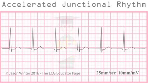 Accelerated Junctional Rhythm