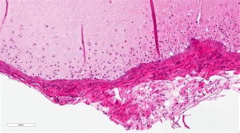 Mucocele Histology