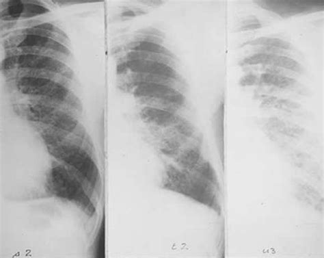 Invasive Ductal Carcinoma Stages Prognosis