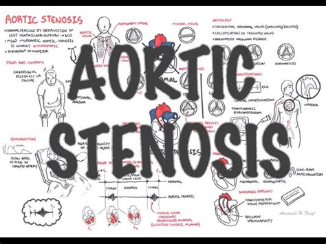 Aortic Stenosis - Overview (signs and symptoms, pathophysiology, treatment) - Medical Discover