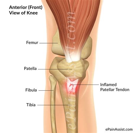 Patellar Tendinitis or Jumper’s Knee|Symptoms|Grades|Treatment-Knee Support