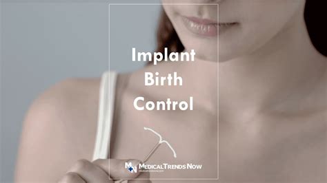 Implant Birth Control In The Philippines: Price, Removal, Pros and Cons – Medical Trends Now