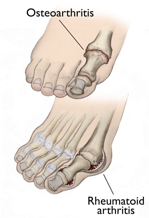 psoriatic arthritis feet Archives - DeNiel Foot and Ankle Center ...