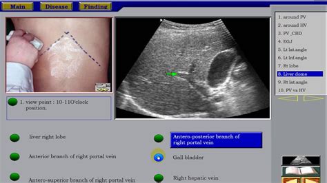 Ultrasound of the Liver 1 in Arabic - YouTube