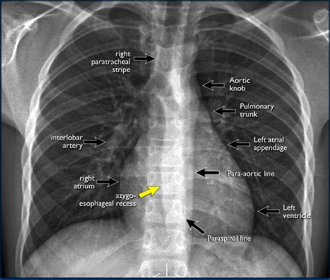 Normal Chest Xray Labeled