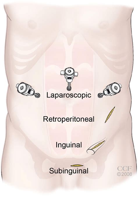 Mind the Gap: Varicocele, Surgery & Gonads (Again) — The Fabled Child