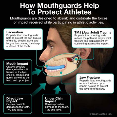 Get Mouth Guards and Sports Guards in Newton, MA - Bubble Children's ...