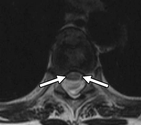 Nontraumatic Spinal Cord Compression: MRI Primer for Emergency Department Radiologists ...