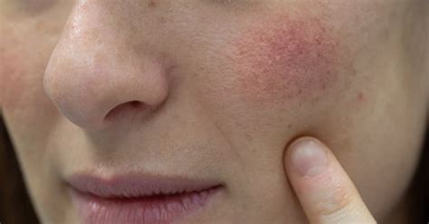 Através Descrição do negócio Empurre para baixo seborrheic dermatitis ...