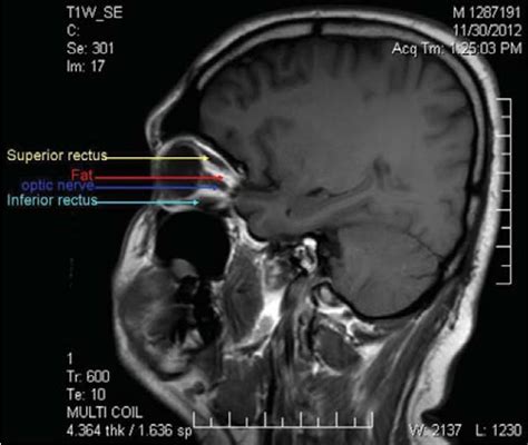 Orbit MRI Anatomy | Radiology Anatomy Images