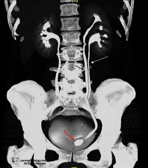 Learning Radiology - Ureterocele, ureterocoele, cobra, head, sign, xray ...