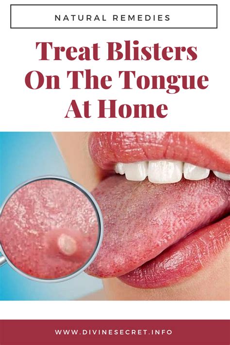 Treat blisters on the tongue at home | Natural remedies, Remedies, Health and wellness quotes