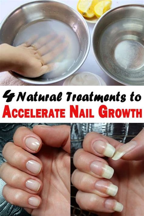 4 Natural Treatments to Accelerate Nail Growth | How to grow nails, Grow nails faster, Nail growth