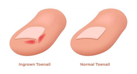 Symptoms of an Ingrown Toenail - Mountainview Foot and Ankle