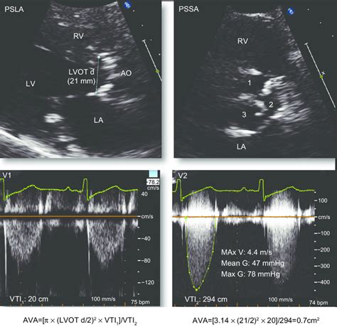 Conventional echo/Doppler measurements in aortic stenosis.... | Download Scientific Diagram