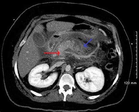 Pancreatitis On Ct Scan