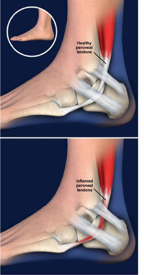 Peroneal Tendonitis Causes Symptoms And Treatment Options | Hot Sex Picture