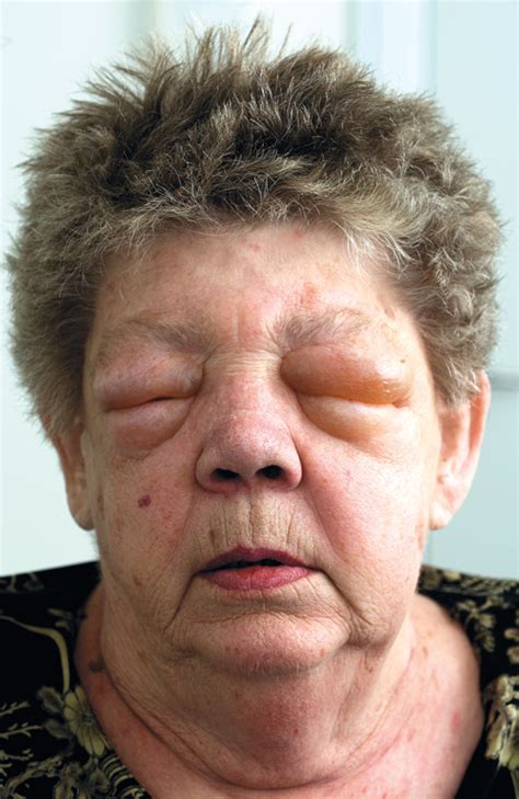 Angioedema – assessment and treatment | Tidsskrift for Den norske ...