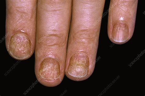 Psoriasis of the fingernails - Stock Image - C051/0056 - Science Photo Library