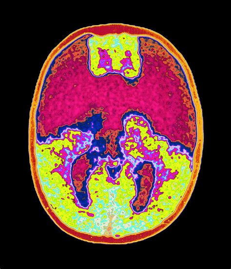 Coloured Mri Brain Scan Showing Holoprosencephaly Photograph by Mehau Kulyk