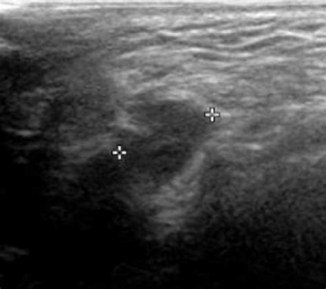 Inguinal sonography. Ultrasonography of the right inguinal area shows a ...